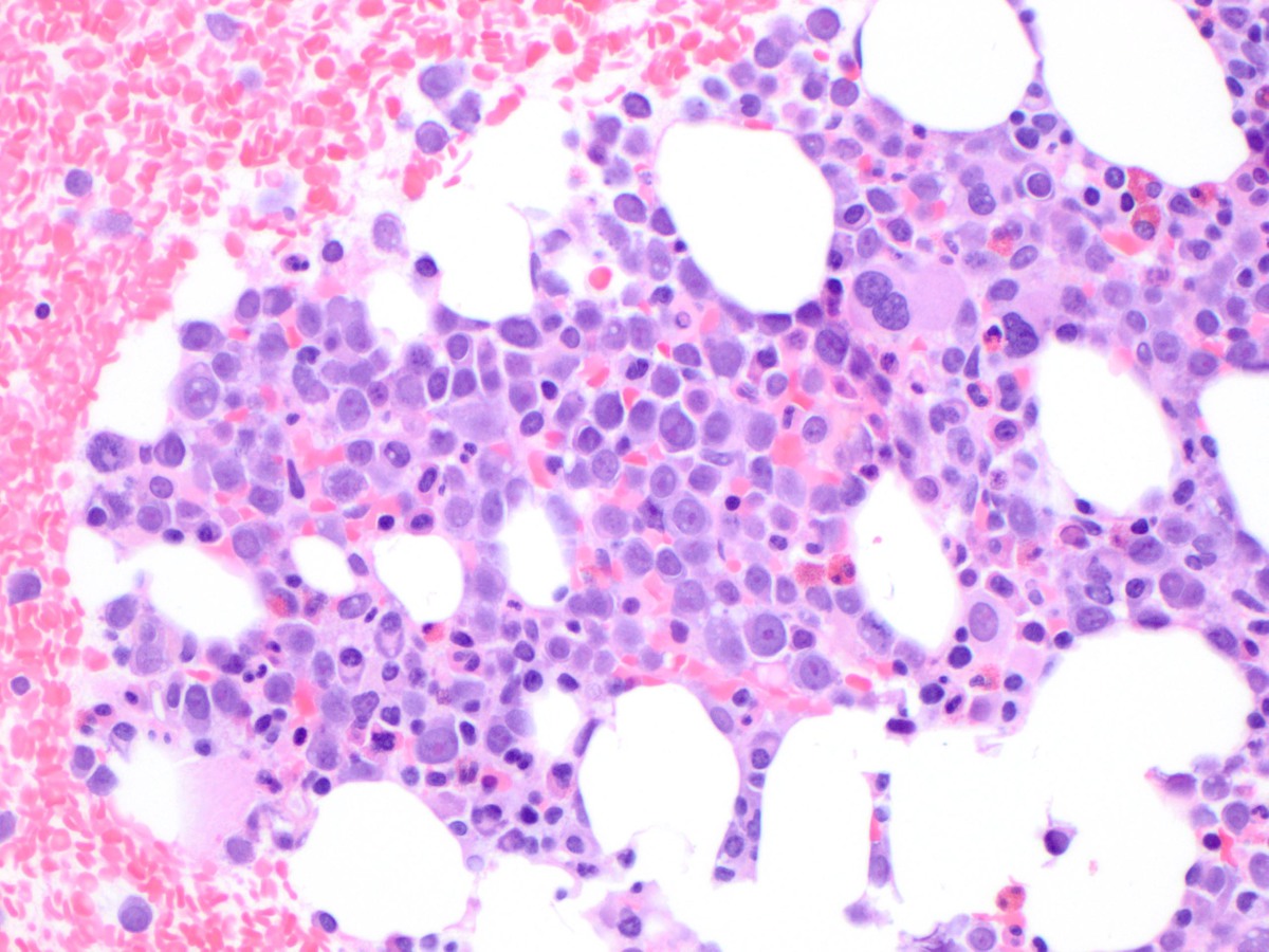 The bone marrow clot section shows a predominant population of immature cells (hematoxylin and eosin, 400x)